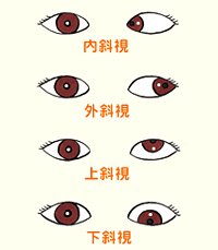 看看兒童斜視眼病怎么預防？