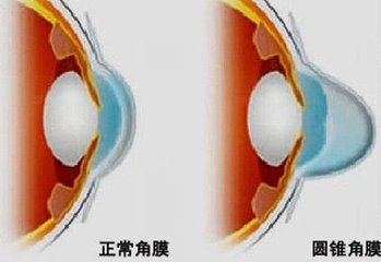 圓錐角膜，哪種角膜移植術好？