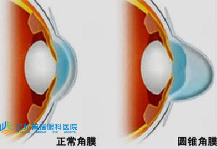 圓錐角膜怎樣？