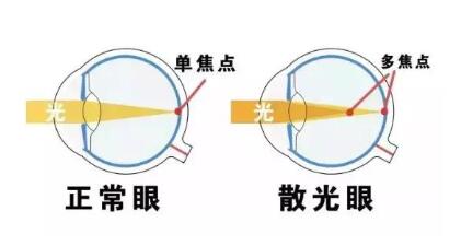 近視和散光，手術(shù)能同時(shí)矯正嗎？