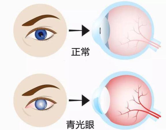 第17個(gè)青光眼周｜共管慢病青光眼，留得光明恒久遠(yuǎn)